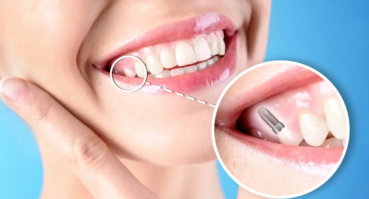 Dental implants replacing missing teeth