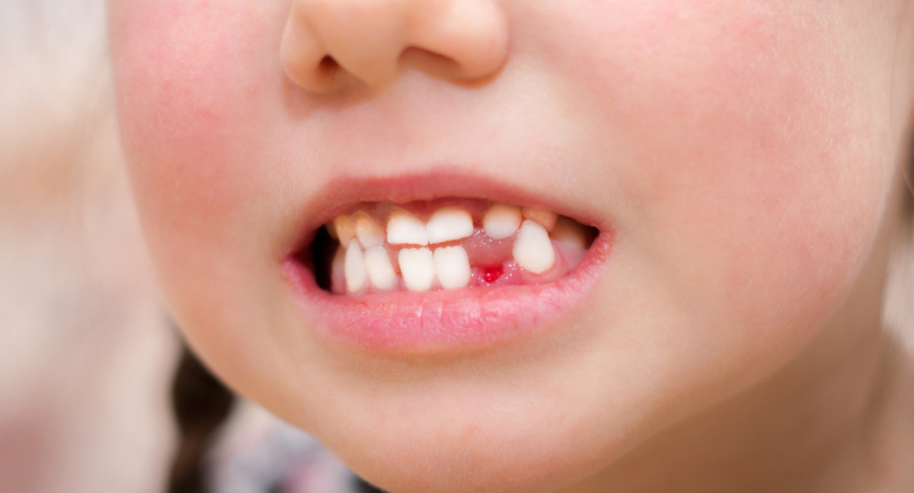 how to stop bleeding after tooth extraction