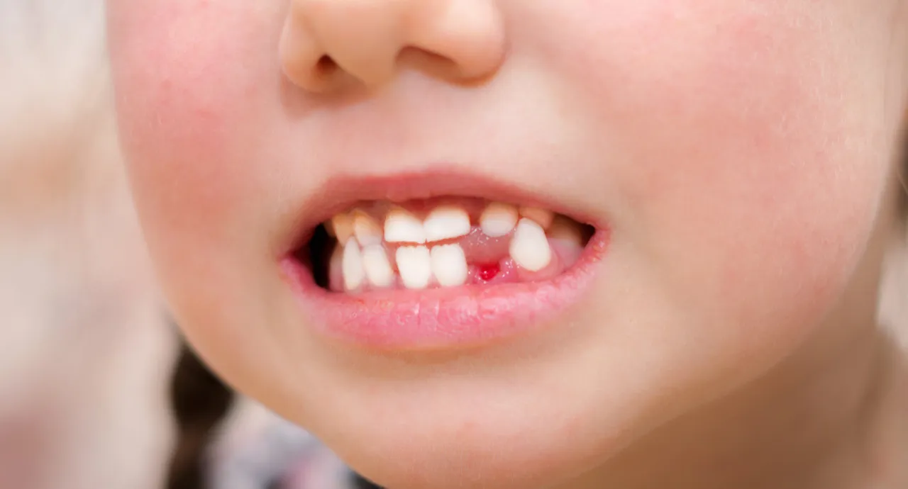 how to stop bleeding after tooth extraction