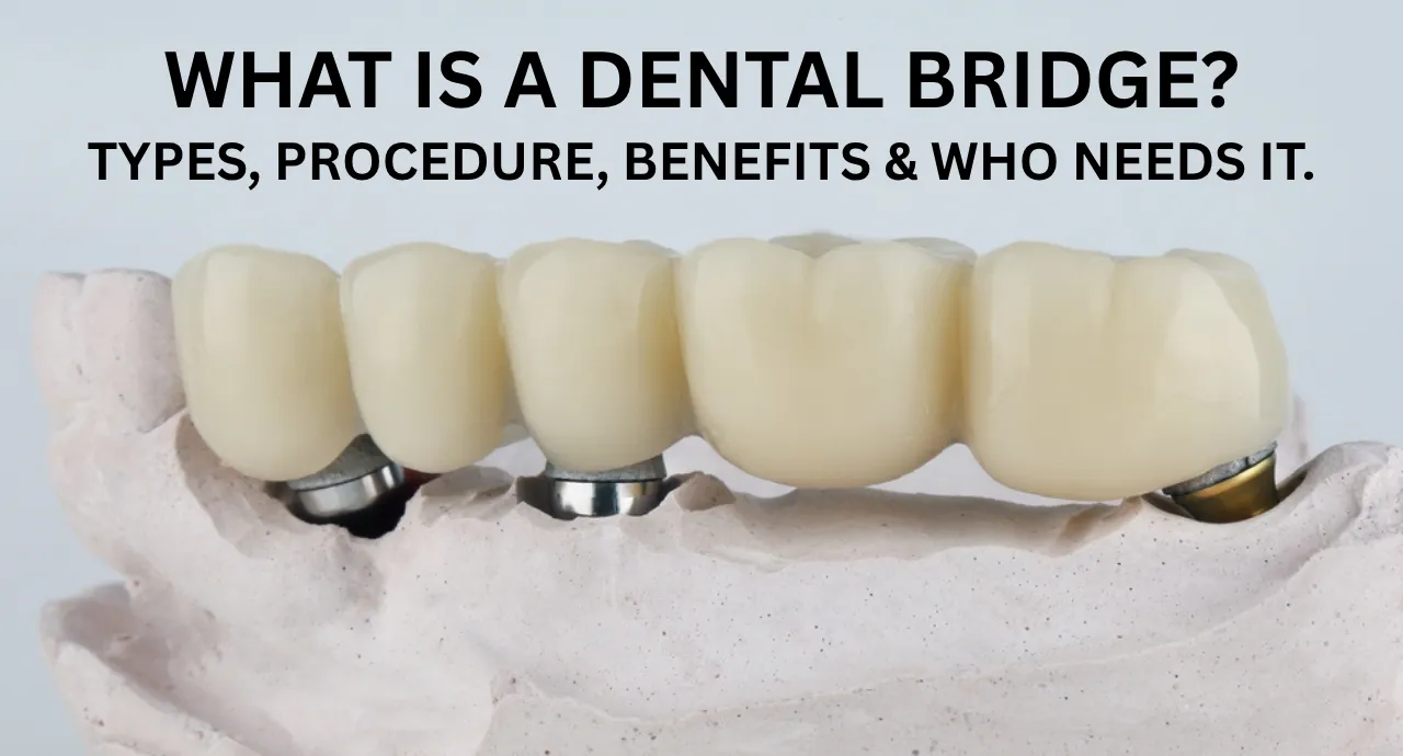 What is a Dental Bridge