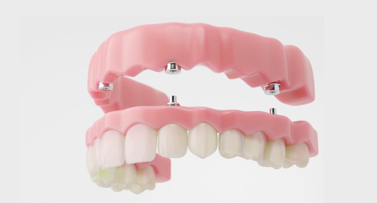 Full Mouth Rehabilitation treatment at Smile Invent Dental Clinic