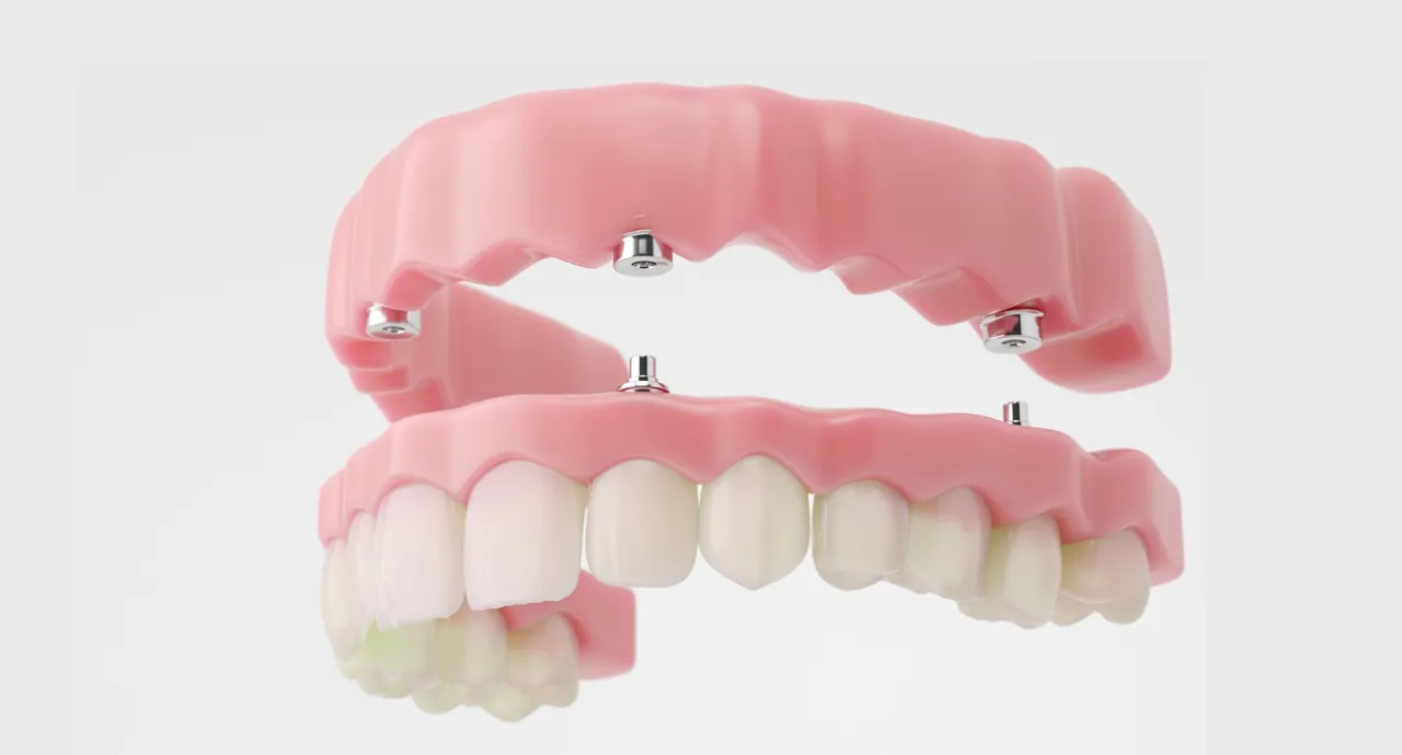 Full Mouth Rehabilitation treatment at Smile Invent Dental Clinic