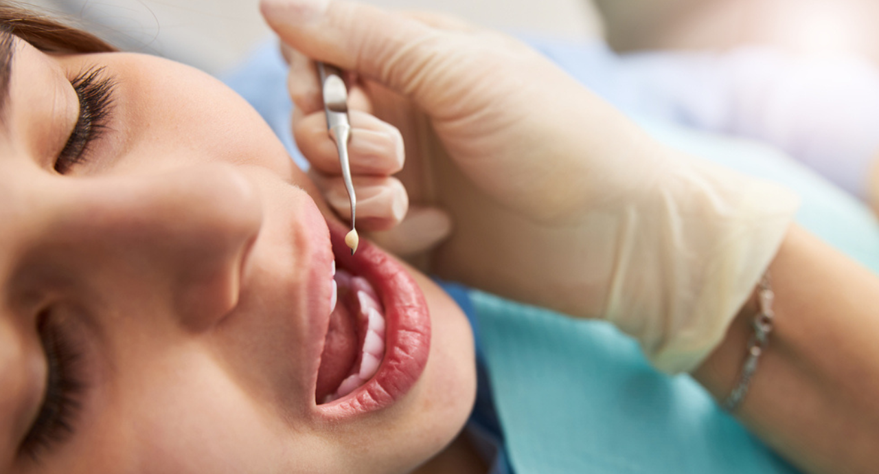 When Is Dental Filling Necessary