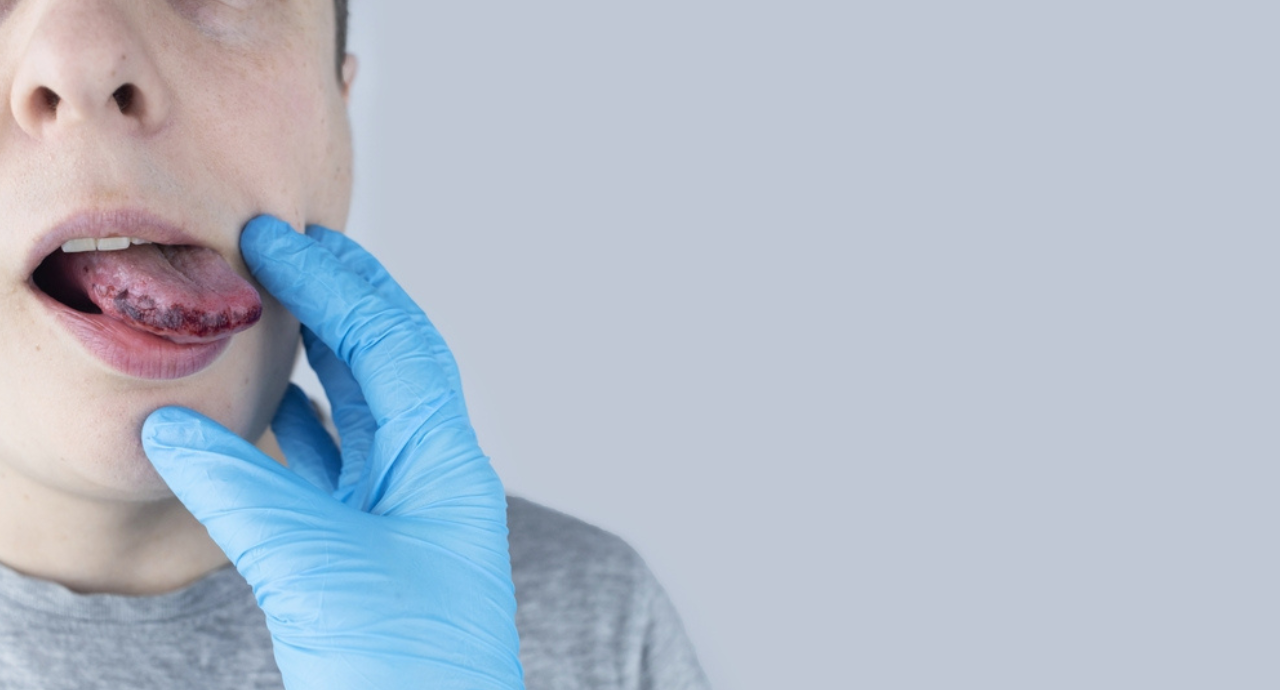 Black spots on tongue