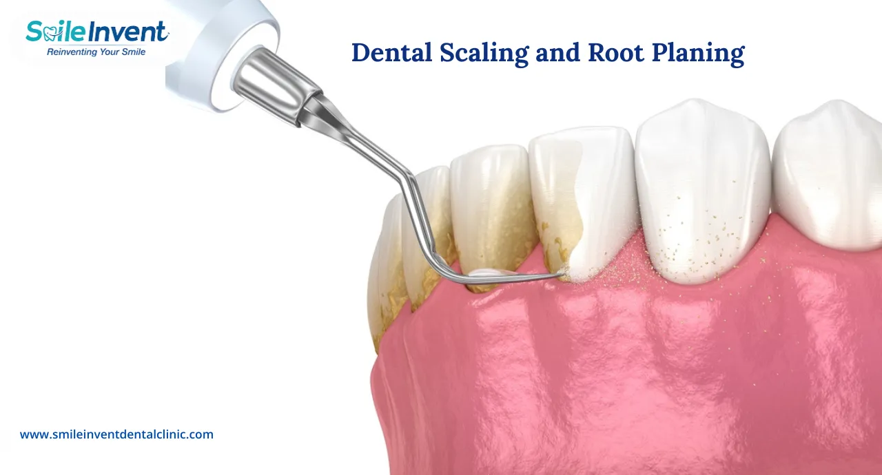 What is Scaling and Root Planing