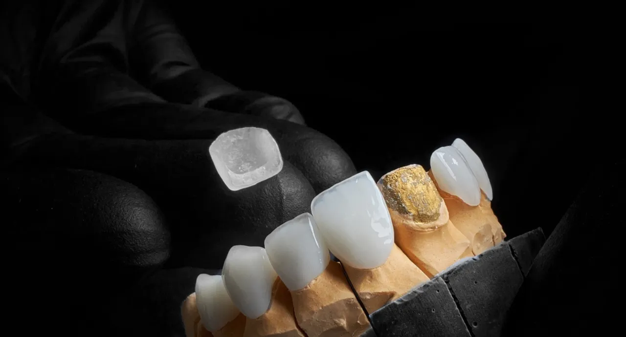 Dental Bonding procedure showing composite resin applied to front tooth