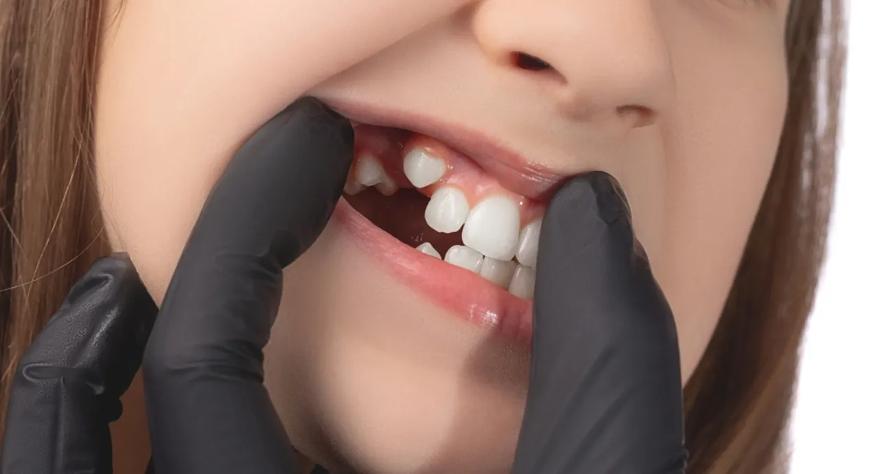 what is a canine tooth